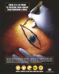 melanoma-removal.jpg.jpeg