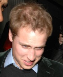 prince-william-hair-loss.jpg