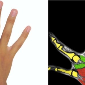 preaxial-polydactyly_1024.jpg