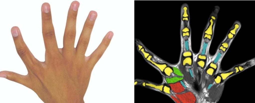 preaxial-polydactyly_1024.jpg
