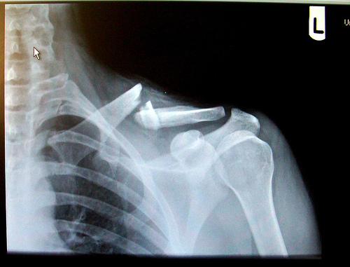 20090323-brokenclav.jpg