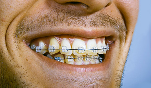 adult-dental-braces.jpg